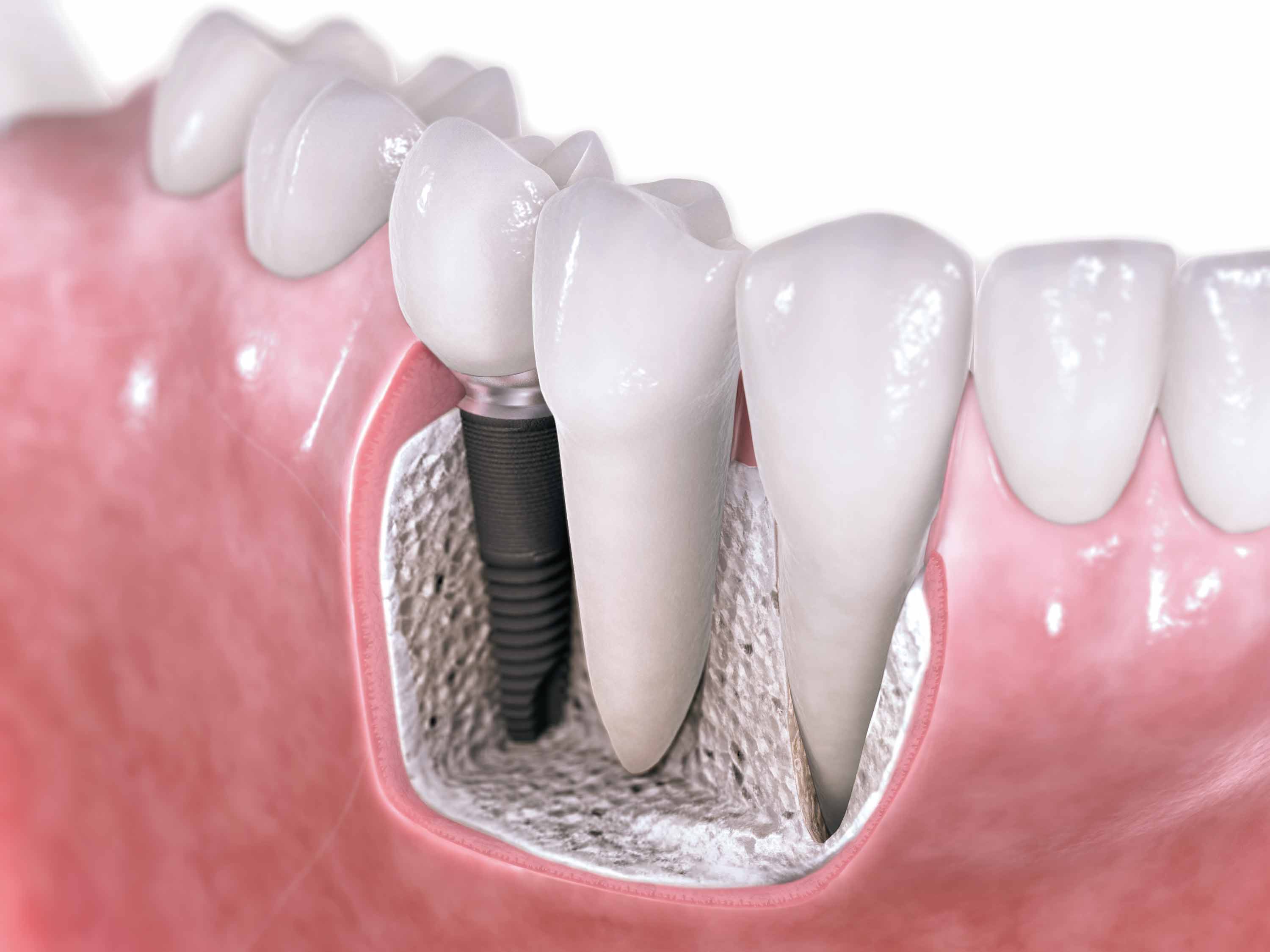 straighten teeth edmonton_implants
