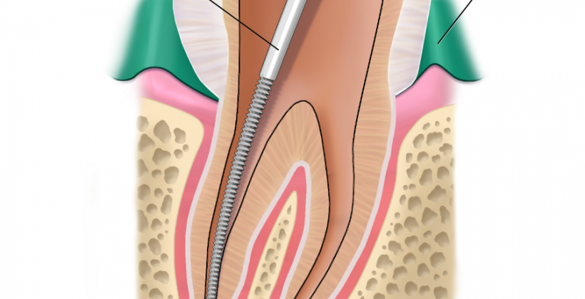 edmonton general dentist_root canal
