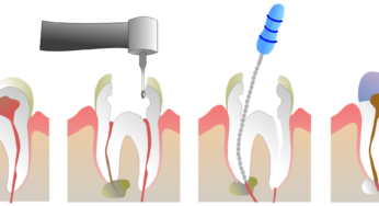 Should You Restore or Extract Your Tooth