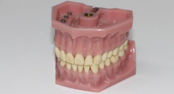 Is It Time For Dentures?