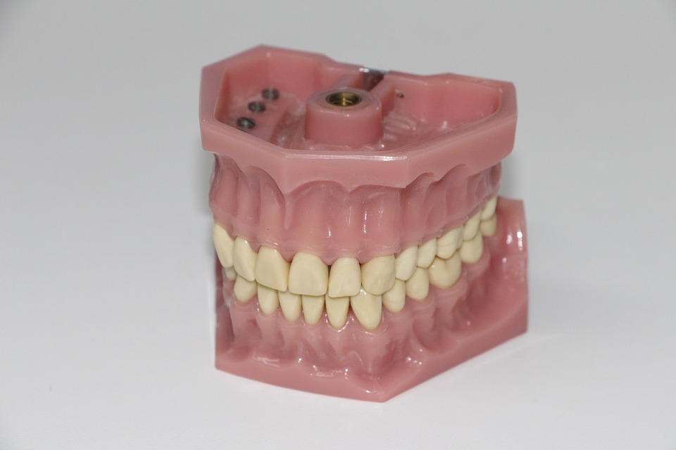 Dental Implants in Edmonton