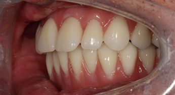 How To Fix An Overbite Without Braces