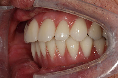 How To Fix An Overbite Without Braces College Plaza Dental Associates