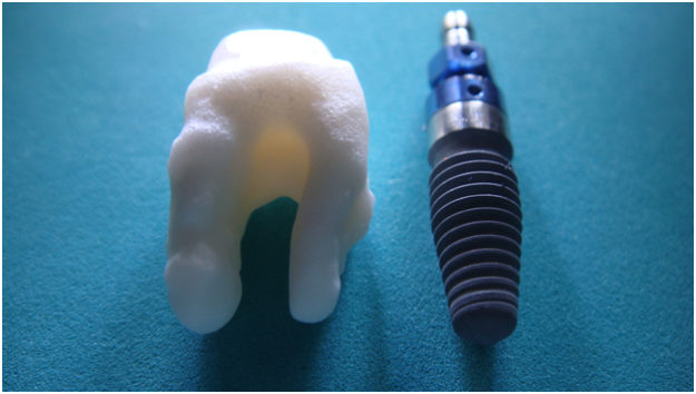 Getting Dental Implants