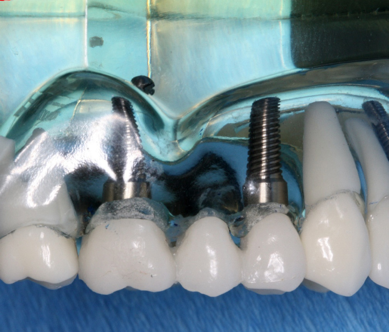 Tooth Bridges or Implants