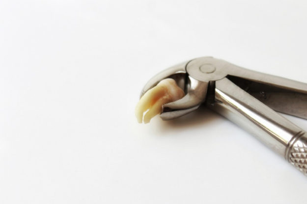 Wisdom Teeth Removal Wisdom Teeth Removal